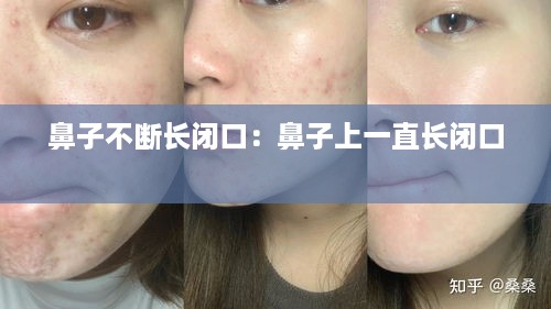鼻子不断长闭口：鼻子上一直长闭口 