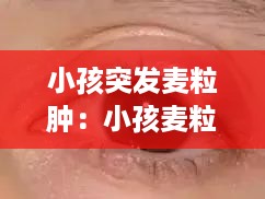 小孩突发麦粒肿：小孩麦粒肿会自愈吗 