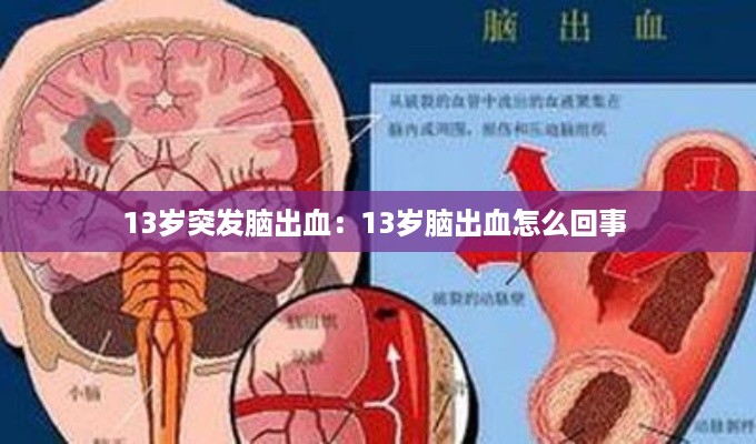 13岁突发脑出血：13岁脑出血怎么回事 