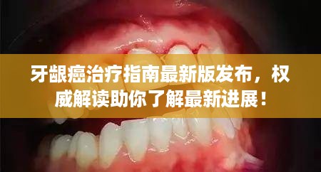 牙龈癌治疗指南最新版发布，权威解读助你了解最新进展！